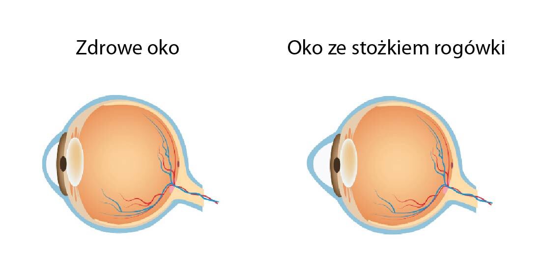 Oko ze stożkiem rogówki